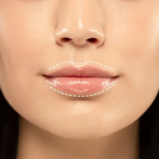 Dermal Fillers Liverpool